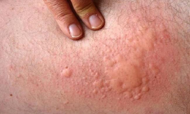 Name:  Symptoms-and-treatment-of-hives.jpg
Views: 483
Size:  30.4 KB